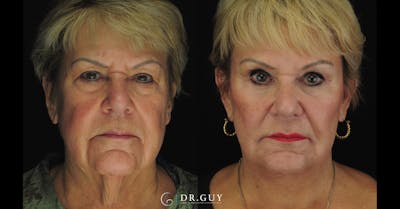 Browlift Before & After Gallery - Patient 388018 - Image 1