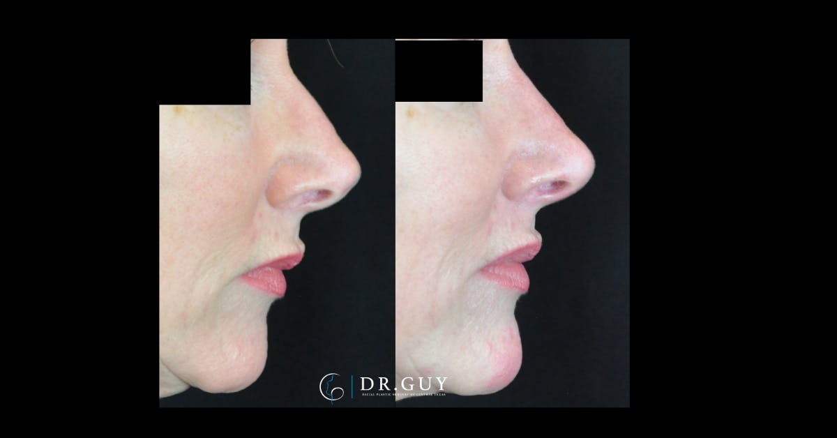 Liquid Rhinoplasty Before & After Gallery - Patient 291999 - Image 1