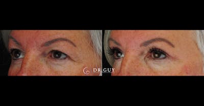 Upper Blepharoplasty Before & After Gallery - Patient 376023 - Image 1