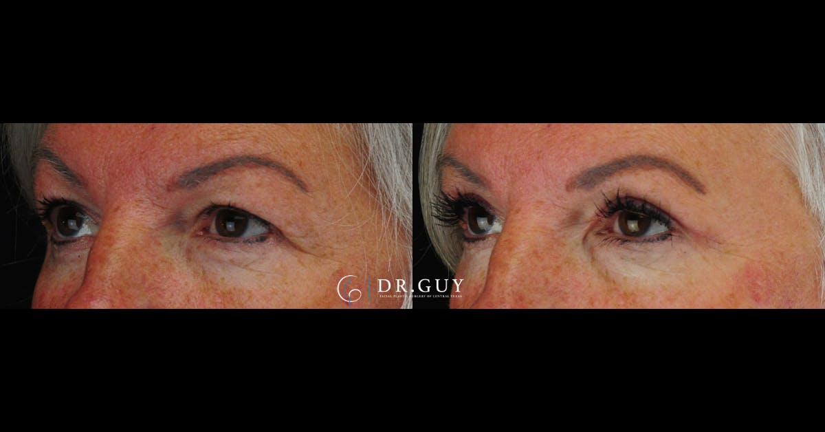Upper Blepharoplasty Before & After Gallery - Patient 376023 - Image 1