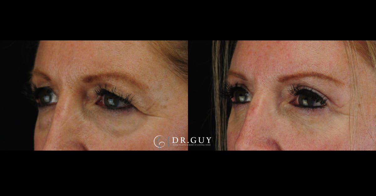 Lower Blepharoplasty Before & After Gallery - Patient 327769 - Image 1