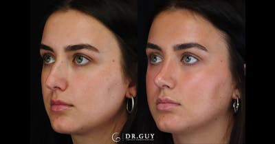 Surgical Rhinoplasty Before & After Gallery - Patient 356079 - Image 1