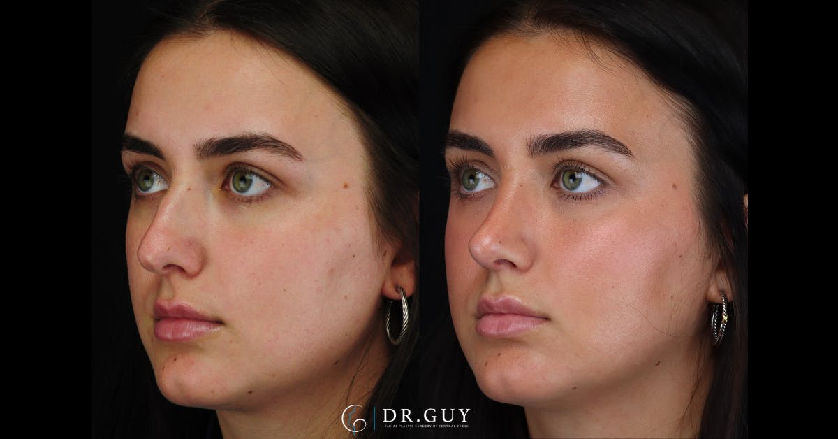 Surgical Rhinoplasty Before & After Gallery - Patient 356079 - Image 1