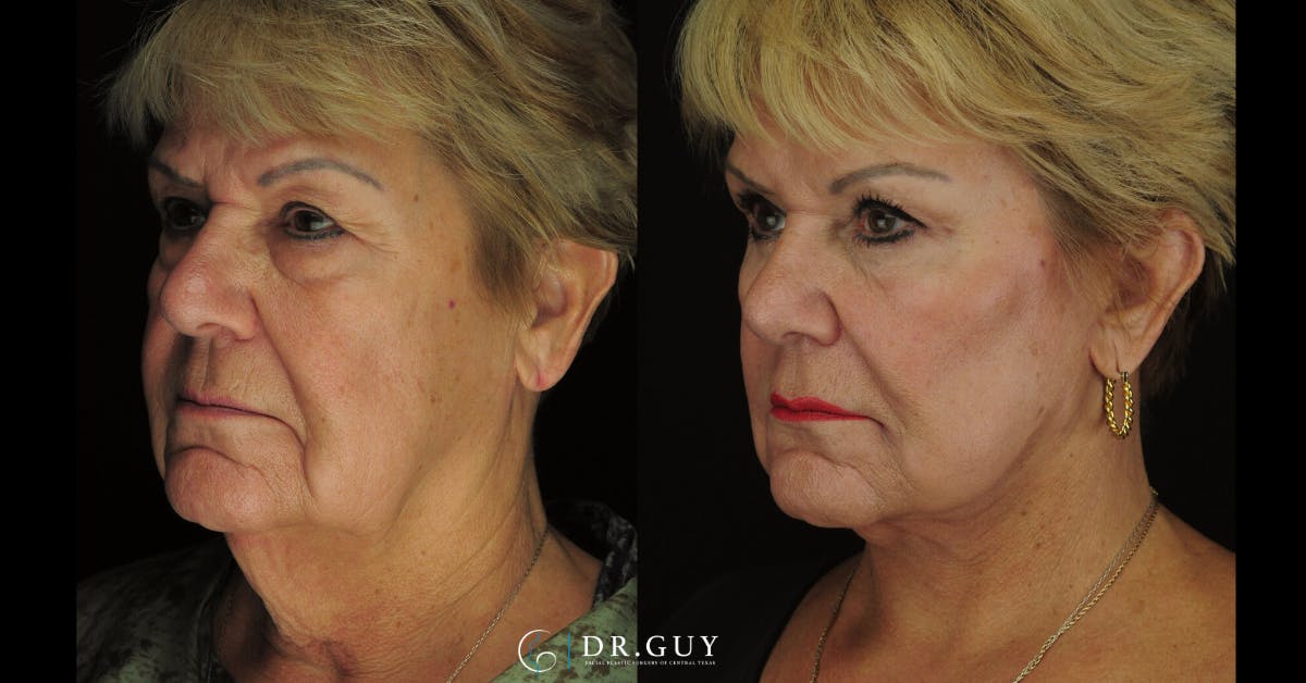 Browlift Before & After Gallery - Patient 388018 - Image 2