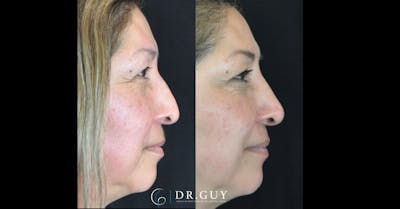 Liquid Rhinoplasty Before & After Gallery - Patient 322561 - Image 1
