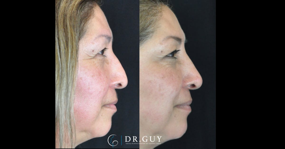 Liquid Rhinoplasty Before & After Gallery - Patient 322561 - Image 1