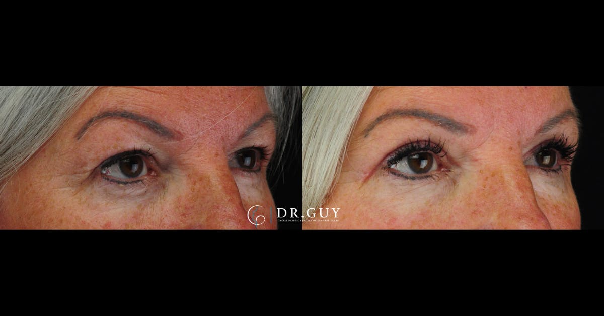 Upper Blepharoplasty Before & After Gallery - Patient 376023 - Image 2