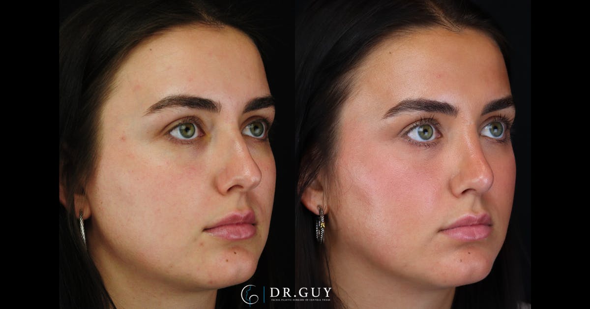 Surgical Rhinoplasty Before & After Gallery - Patient 356079 - Image 2