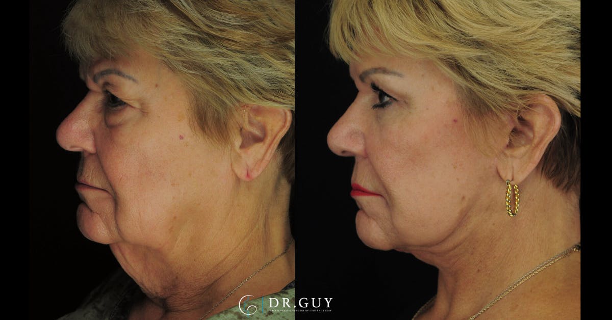 Browlift Before & After Gallery - Patient 388018 - Image 3