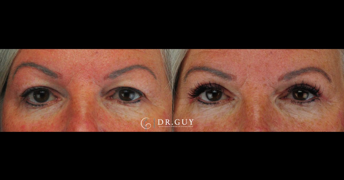 Upper Blepharoplasty Before & After Gallery - Patient 376023 - Image 3