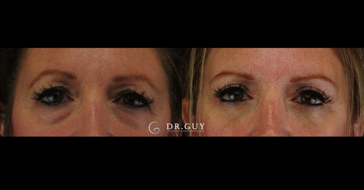Lower Blepharoplasty Before & After Gallery - Patient 327769 - Image 3