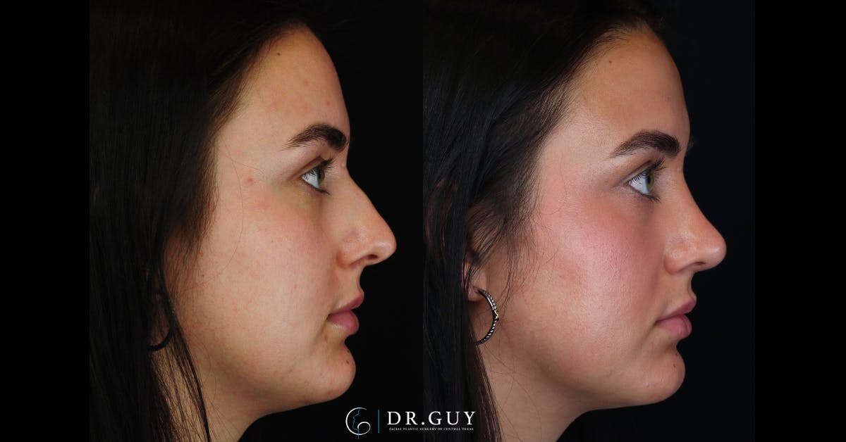 Surgical Rhinoplasty Before & After Gallery - Patient 356079 - Image 3