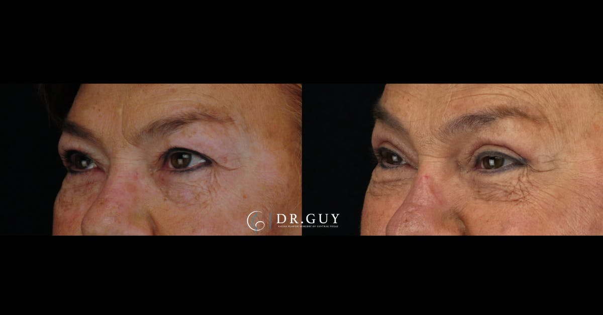 Upper Blepharoplasty Before & After Gallery - Patient 235560 - Image 1