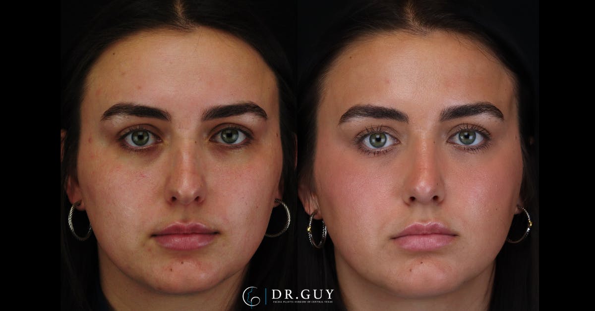 Surgical Rhinoplasty Before & After Gallery - Patient 356079 - Image 4