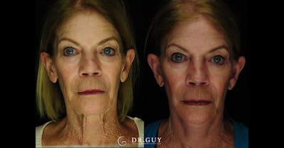 Mini Facelift Before & After Gallery - Patient 407900 - Image 1