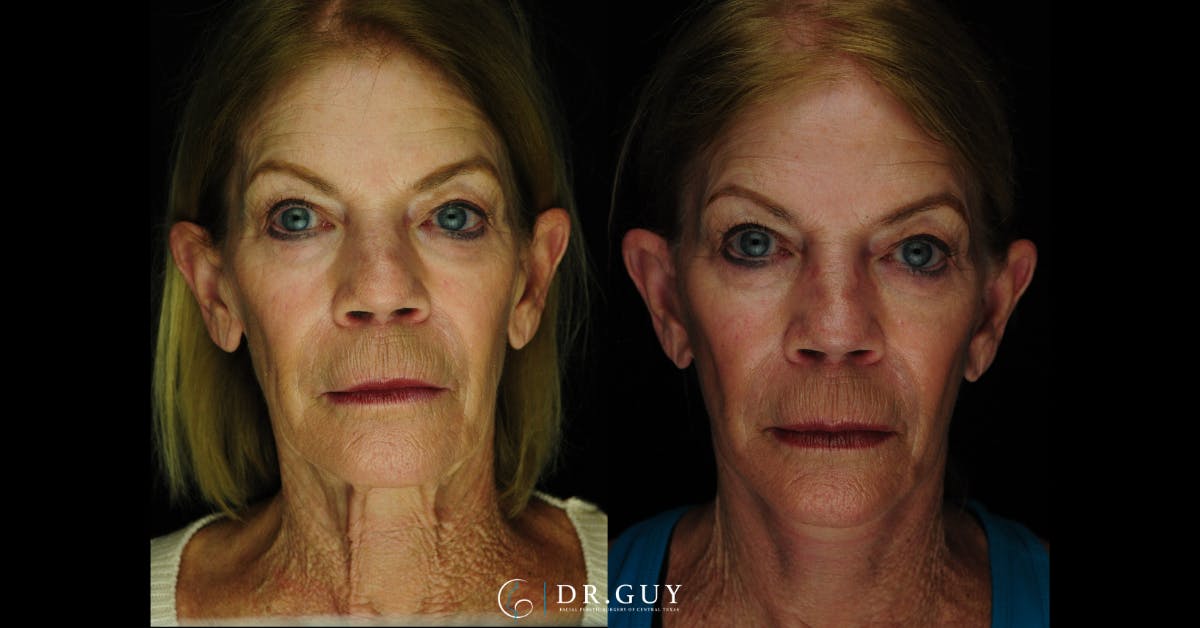 Mini Facelift Before & After Gallery - Patient 407900 - Image 1