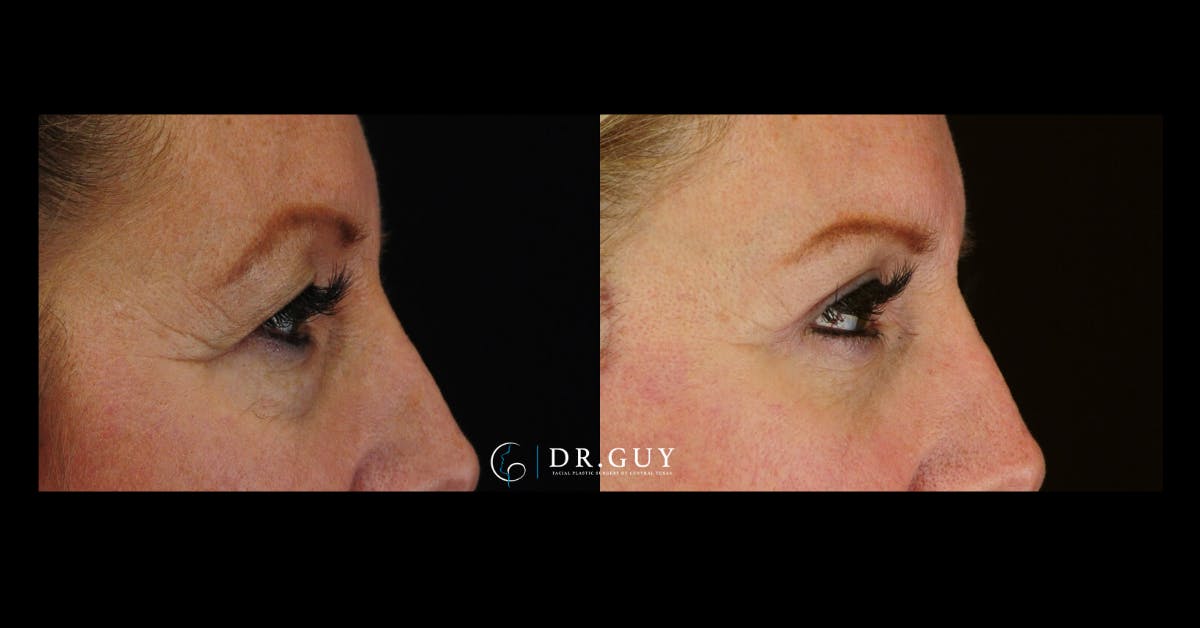 Lower Blepharoplasty Before & After Gallery - Patient 327769 - Image 5
