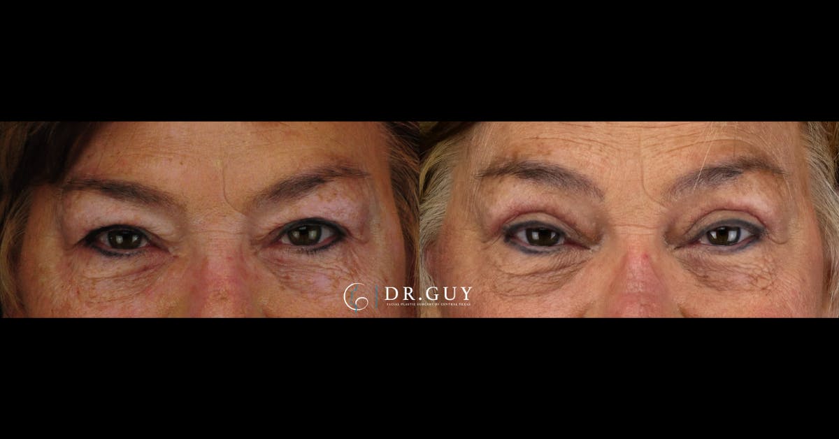 Upper Blepharoplasty Before & After Gallery - Patient 235560 - Image 2