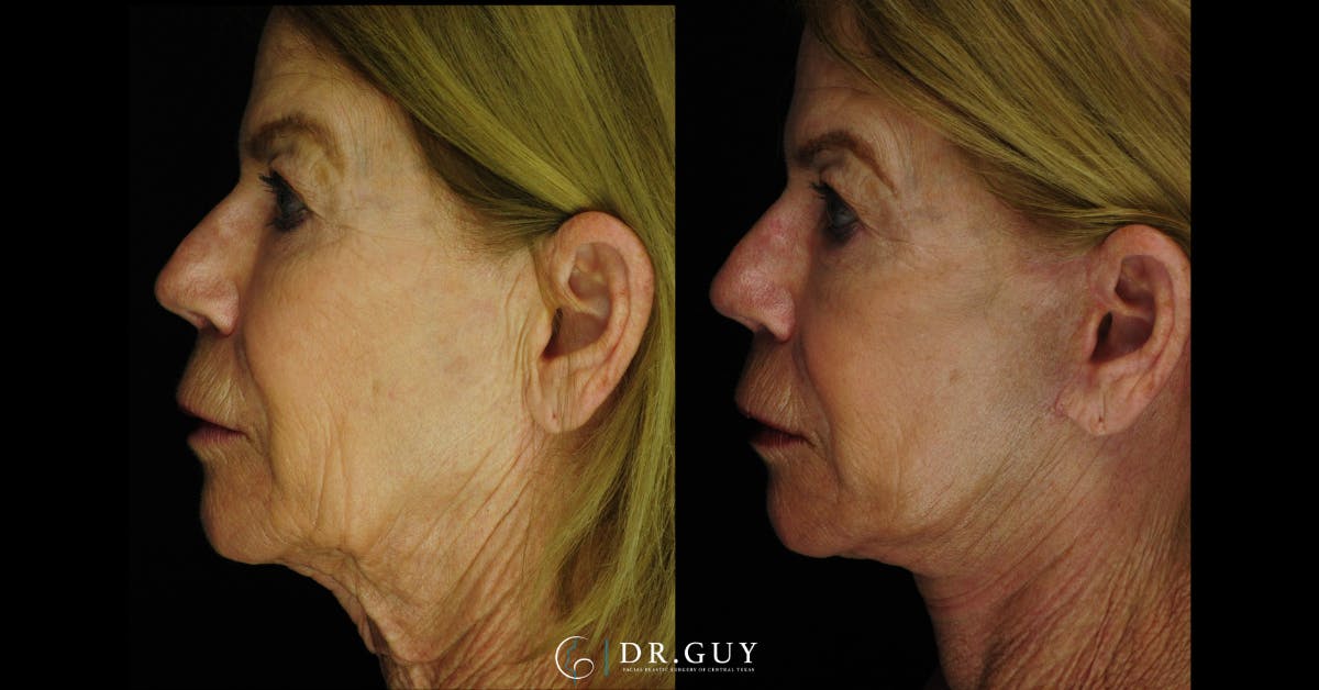 Mini Facelift Before & After Gallery - Patient 407900 - Image 2