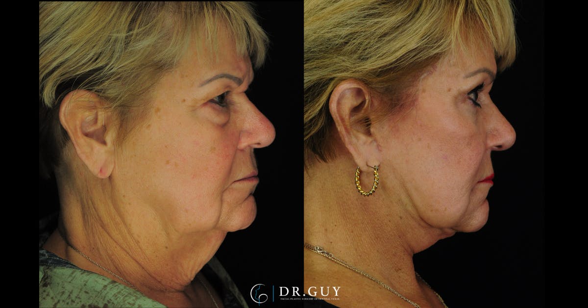 Browlift Before & After Gallery - Patient 388018 - Image 5