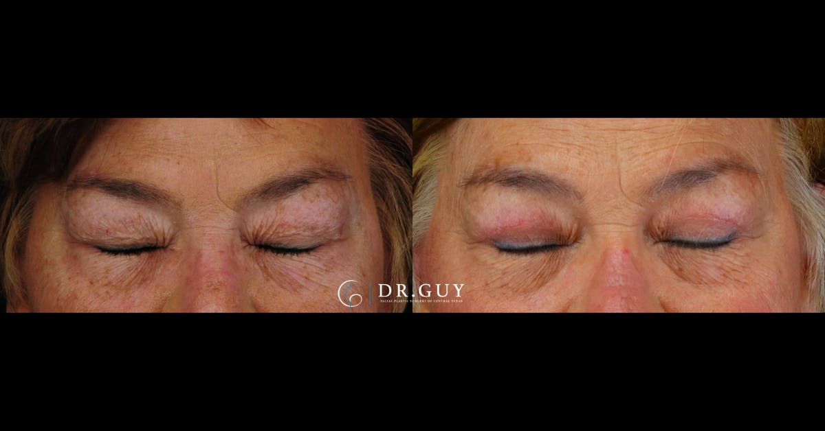 Upper Blepharoplasty Before & After Gallery - Patient 235560 - Image 3