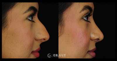 Surgical Rhinoplasty Before & After Gallery - Patient 369851 - Image 1