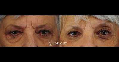 Lower Blepharoplasty Before & After Gallery - Patient 389385 - Image 1