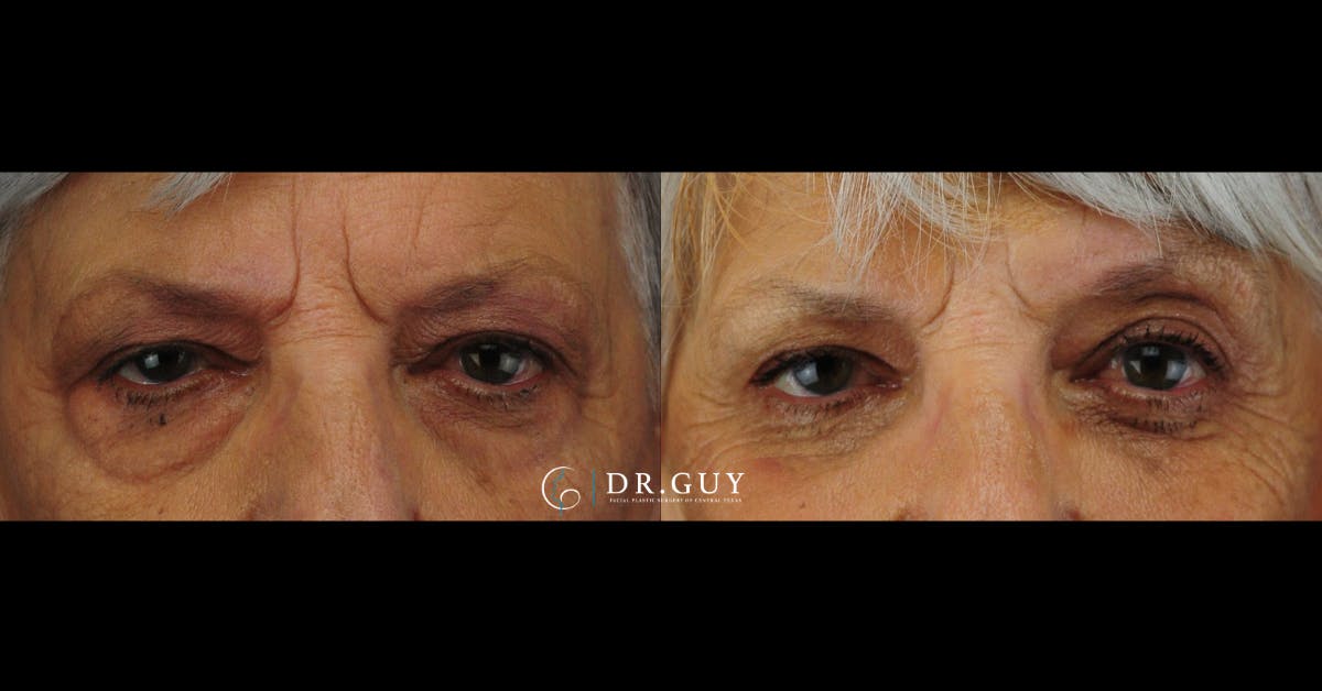 Lower Blepharoplasty Before & After Gallery - Patient 389385 - Image 1