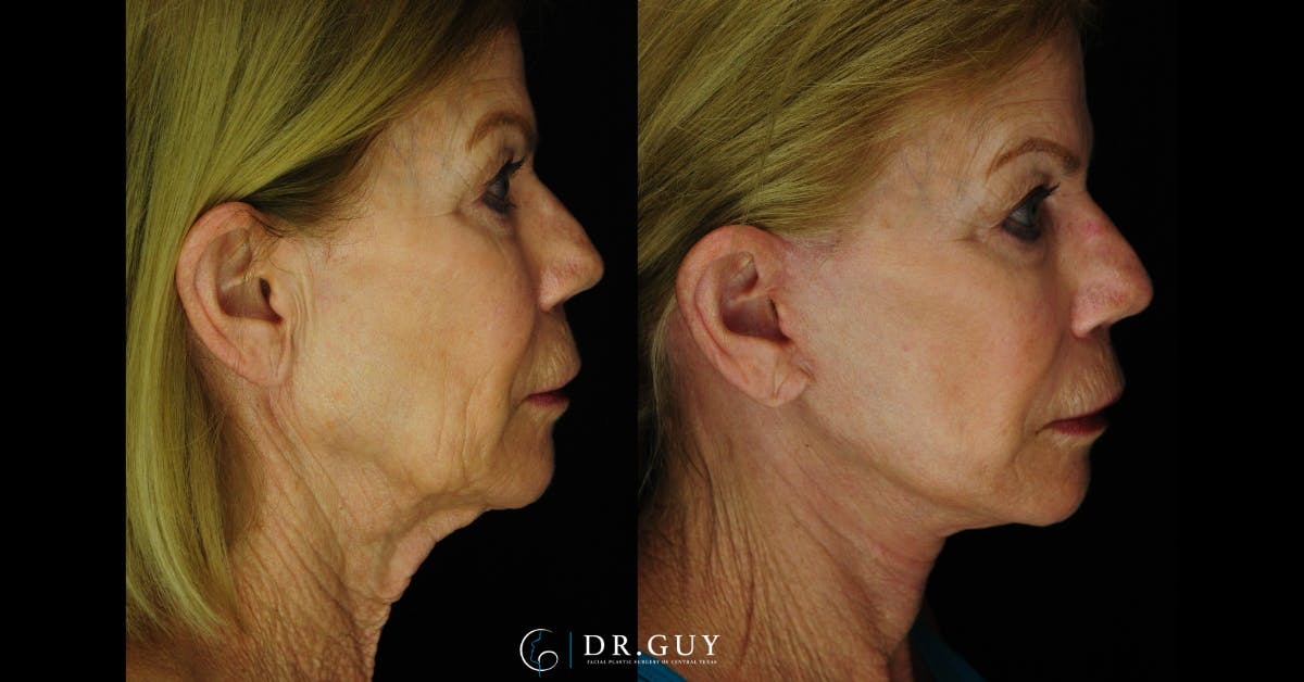 Mini Facelift Before & After Gallery - Patient 407900 - Image 3