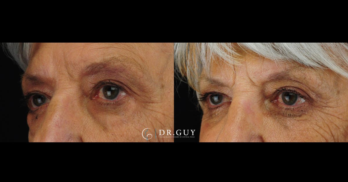 Lower Blepharoplasty Before & After Gallery - Patient 389385 - Image 2