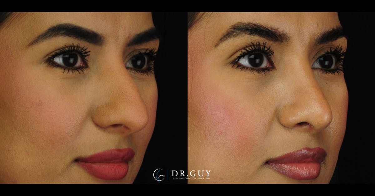 Surgical Rhinoplasty Before & After Gallery - Patient 369851 - Image 2