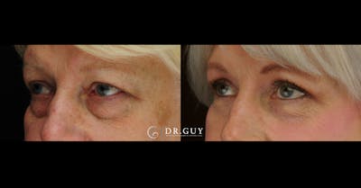 Upper Blepharoplasty Before & After Gallery - Patient 114951 - Image 1