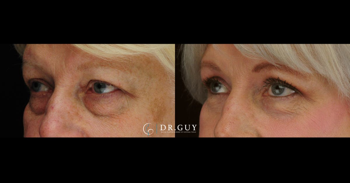 Upper Blepharoplasty Before & After Gallery - Patient 114951 - Image 1