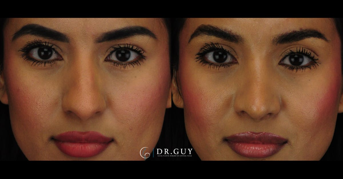 Surgical Rhinoplasty Before & After Gallery - Patient 369851 - Image 3