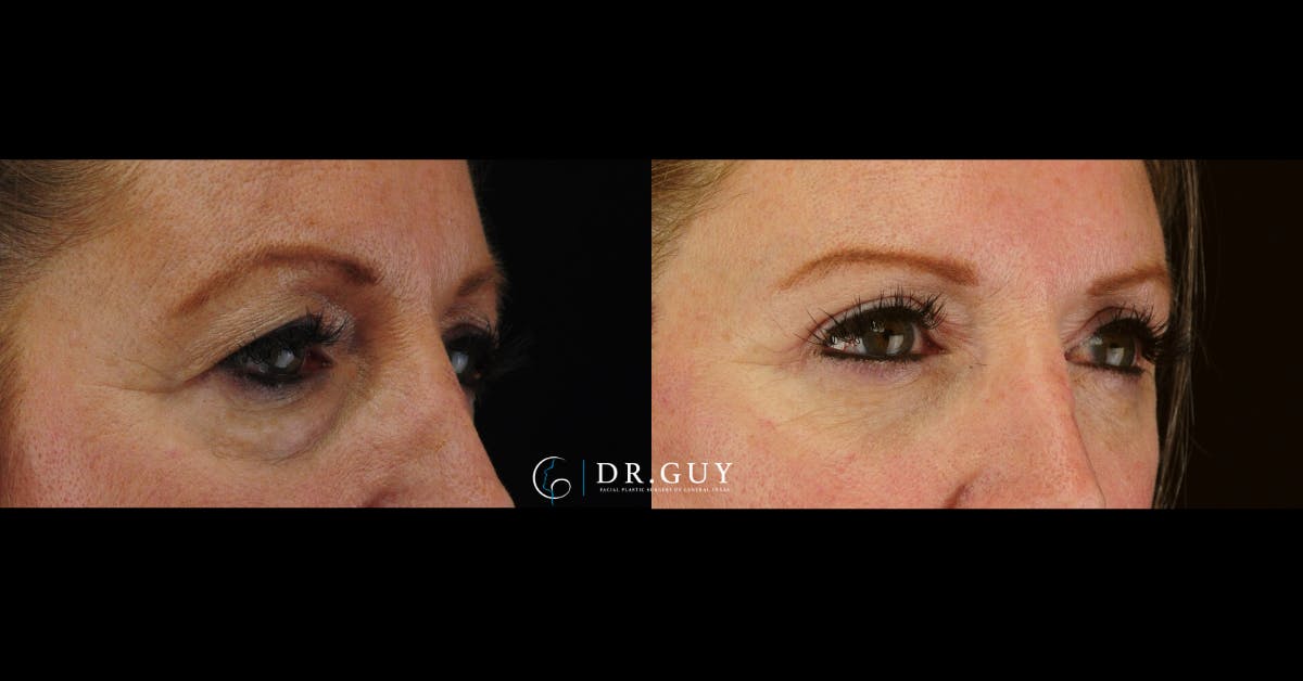 Browlift Before & After Gallery - Patient 412780 - Image 2