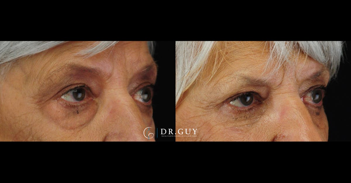 Lower Blepharoplasty Before & After Gallery - Patient 389385 - Image 3