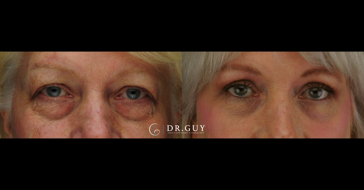 Upper Blepharoplasty Before & After Gallery - Patient 114951 - Image 3