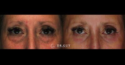Lower Blepharoplasty Before & After Gallery - Patient 419512 - Image 1