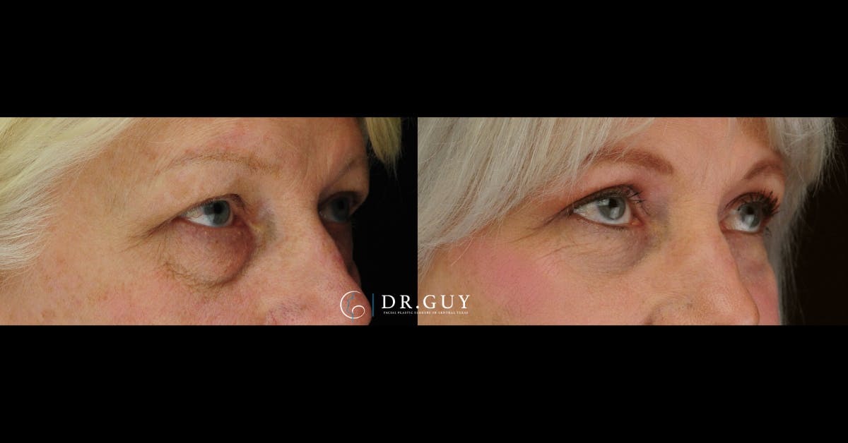 Upper Blepharoplasty Before & After Gallery - Patient 114951 - Image 4