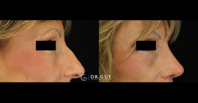 Surgical Rhinoplasty Before & After Gallery - Patient 365329 - Image 1