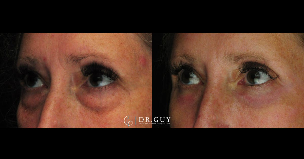 Lower Blepharoplasty Before & After Gallery - Patient 419512 - Image 2