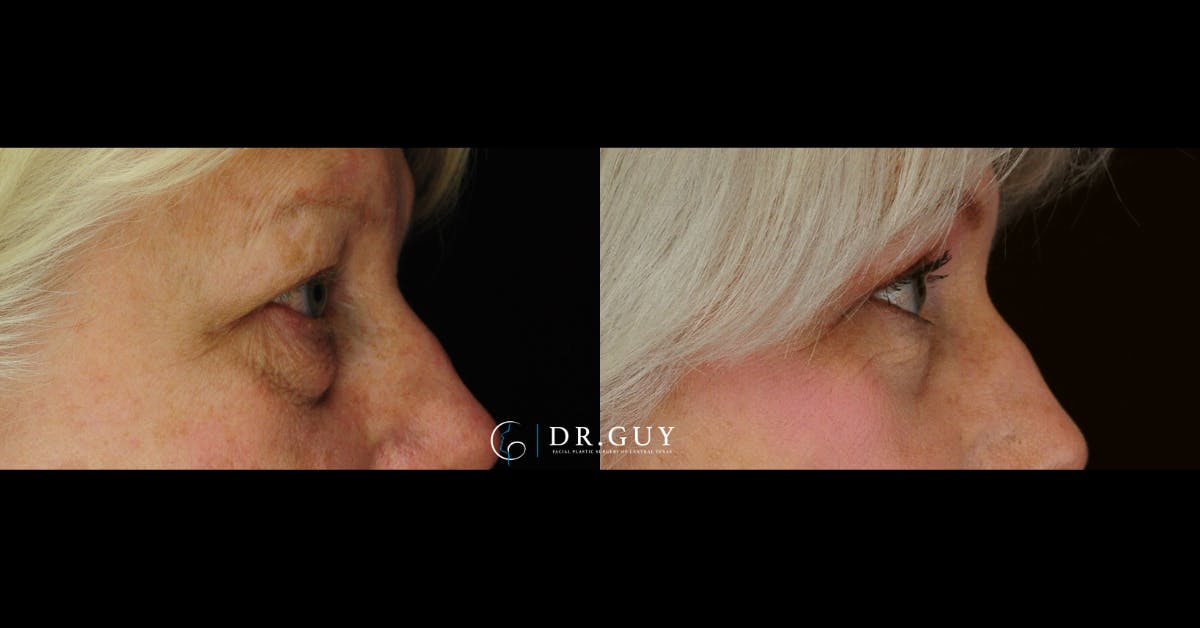 Upper Blepharoplasty Before & After Gallery - Patient 114951 - Image 5