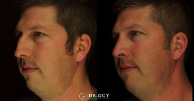 Surgical Rhinoplasty Before & After Gallery - Patient 179347 - Image 1