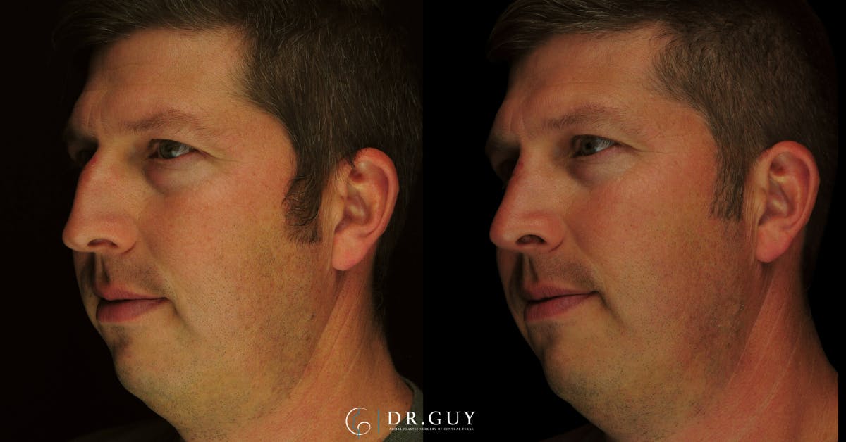 Surgical Rhinoplasty Before & After Gallery - Patient 179347 - Image 1