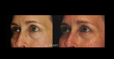 Browlift Before & After Gallery - Patient 251117 - Image 1