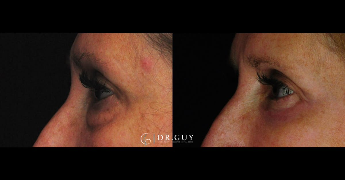 Lower Blepharoplasty Before & After Gallery - Patient 419512 - Image 3