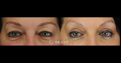 Upper Blepharoplasty Before & After Gallery - Patient 219944 - Image 1