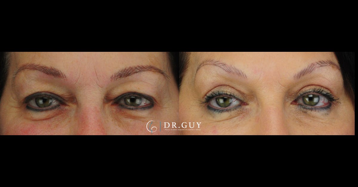 Upper Blepharoplasty Before & After Gallery - Patient 219944 - Image 1