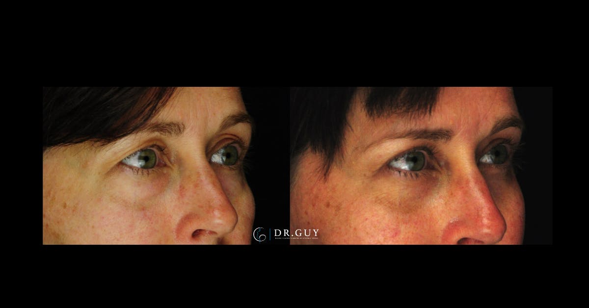 Browlift Before & After Gallery - Patient 251117 - Image 2