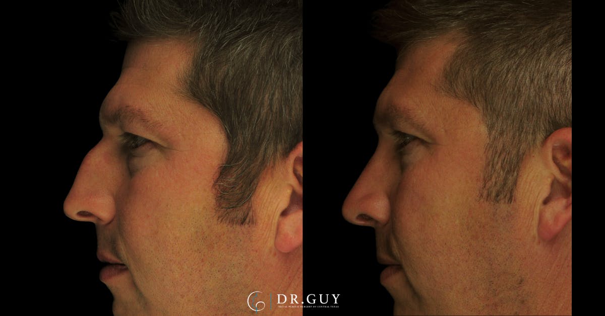 Surgical Rhinoplasty Before & After Gallery - Patient 179347 - Image 2